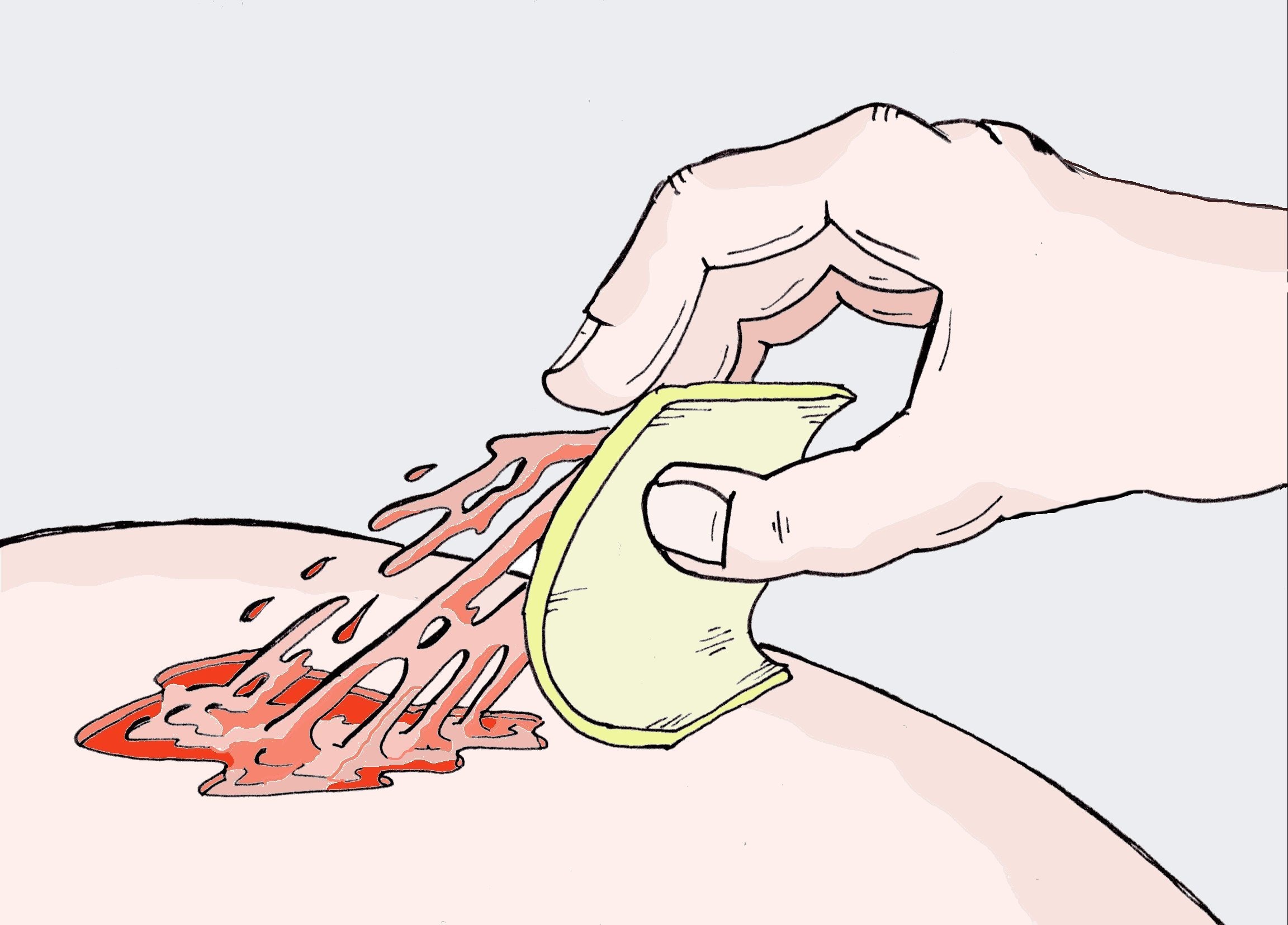 Verletzungsgefahr durch anhaftenden Wundverband