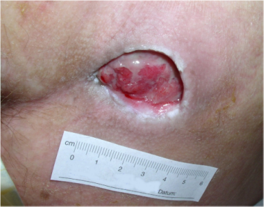 Foto Wunde Dekubitus