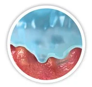 illustration of Micro-Contours to Wound Bed