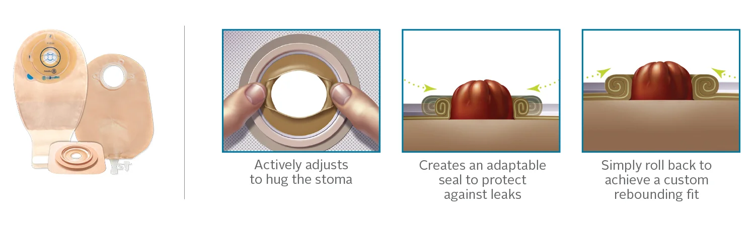 Irregular Stoma Shape - website image