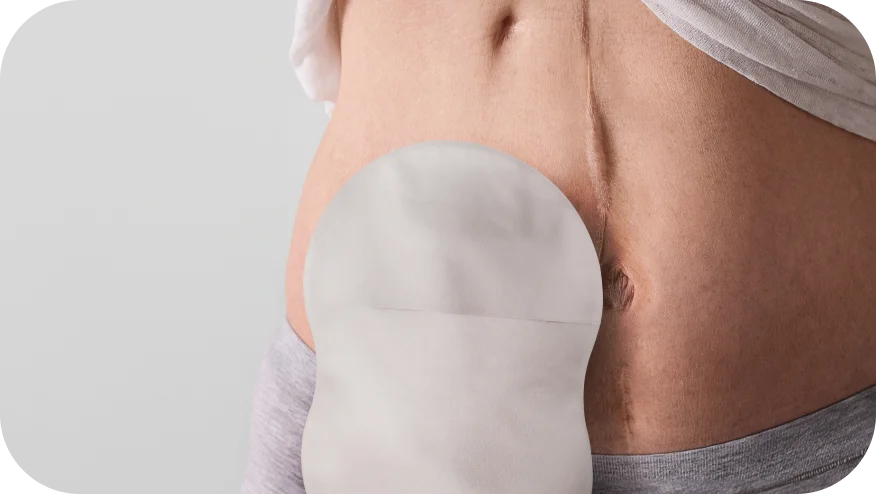 ストーマ袋を付けた腹部